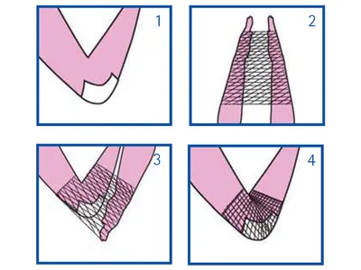 Plasă tubulară elastică C pentru mână, cot, braț - fără latex